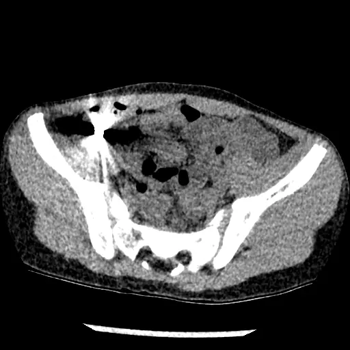 Corte axial de tomografia de abdome e pelve pediátrica de base pública